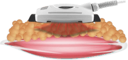 Laser 980 - grossiste esthetique scarlett the beauty centre - LLLT effet schema
