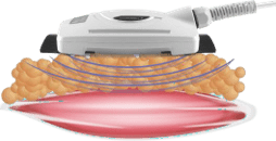 Laser 980 - grossiste esthetique scarlett the beauty centre - electromodelage effet schema